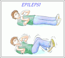 Obat Kejang Epilepsi Menahun